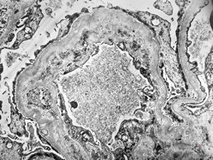 F,18y. | type I membranoproliferative glomerulonephritis